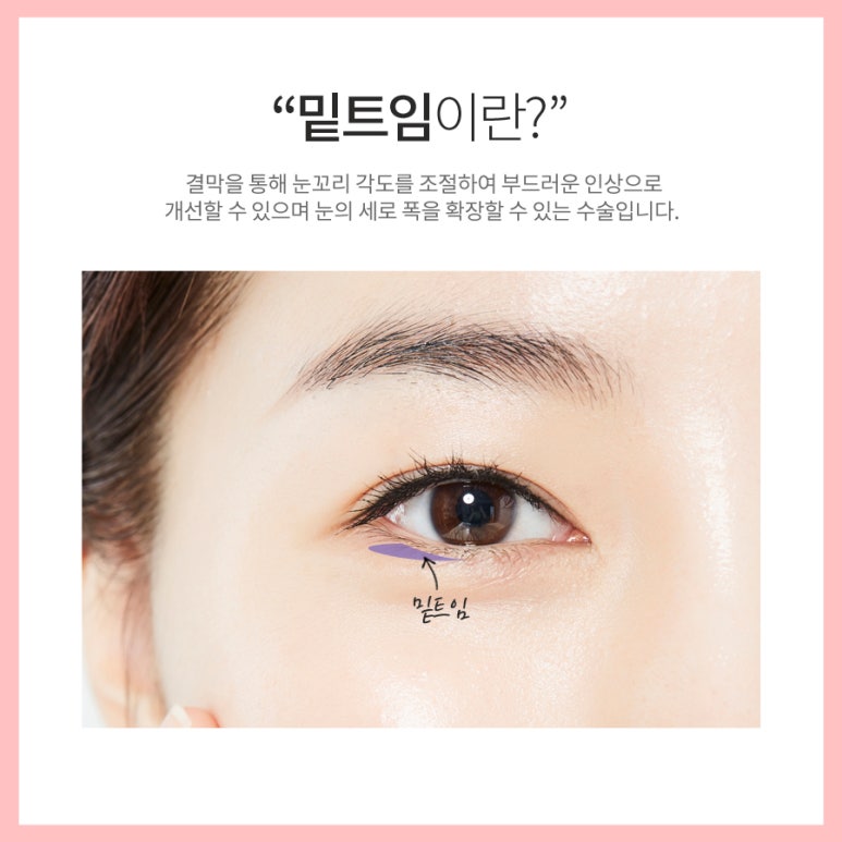 눈밑트임 부드러운 이미지로! 마블성형외과의원 관련 이미지 6