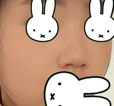 [강남성형외과 복코성형 후기] 두꺼운 피부라 얄쌍해지기 어렵다던 제 복코.. 지금은 콧볼까지 얇아졌어요 관련 이미지 3
