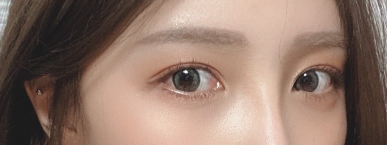 자연유착쌍꺼풀 흉터 풀림 고민 말고 내추럴함!마블성형외과의원 관련 이미지 2
