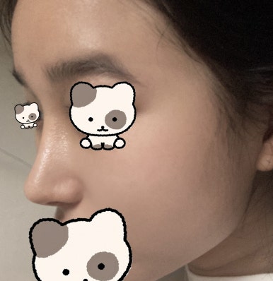 [Gangnam Station Plastic Surgery Hump Nose Surgery Review] I Escaped the Hump That Fillers Couldn’t Fix! It Looks Prettier with a Slim, Straight Line Haha image 9