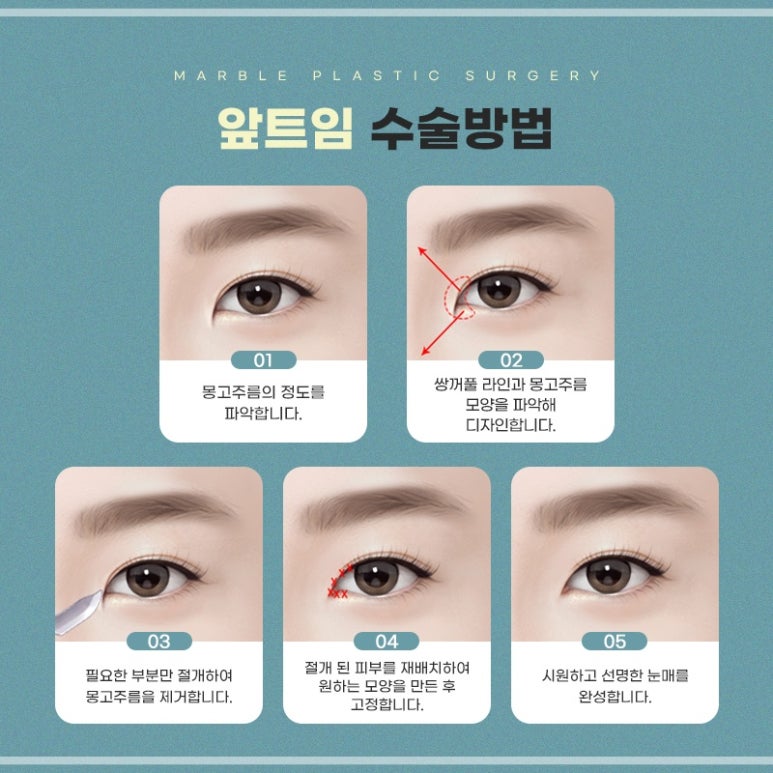 앞트임복원, 흉터걱정없이 깔끔하게 관련 이미지 4