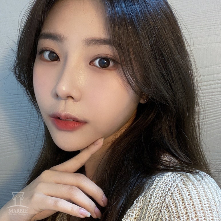 쌍수 눈매교정 앞트임 Q&A!마블성형외과의원 관련 이미지 1
