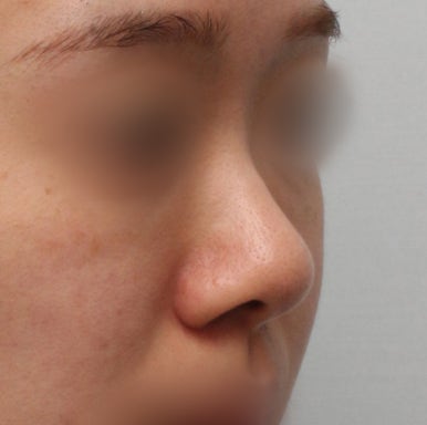 [Gangnam Plastic Surgery Bulbous Nose Surgery Review] I Was Stressed About My Nose Filler Spreading... but the Natural-Looking Straight-Line Profile Was a Huge Success! Haha image 3