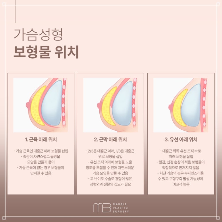 모티바가슴성형추천 BEST 병원, 마블성형외과의원이 선택받는 이유 관련 이미지 6