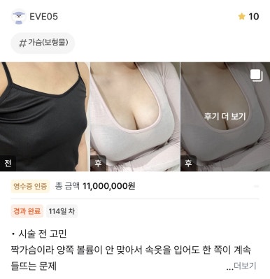 [Gangnam Plastic Surgery Breast Augmentation Real Review] My asymmetry was so severe that my underwear gapedㅠㅠ Customized volumes for each side solved my concern! image 1