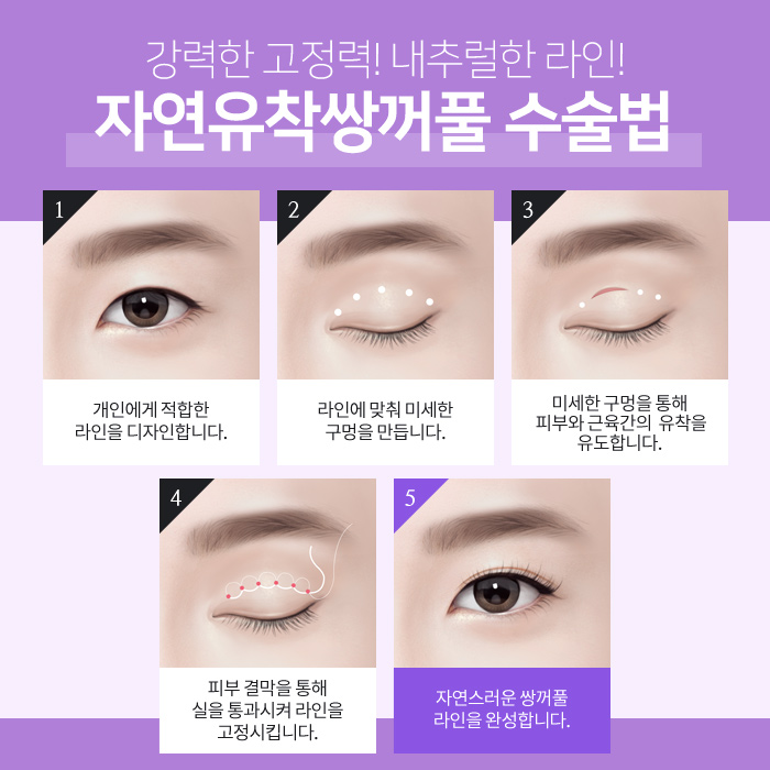 쌍꺼풀수술전후 내추럴한 인상으로 거듭나!마블성형외과의원 관련 이미지 7