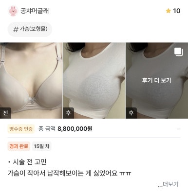 [Gangnam Plastic Surgery Breast Augmentation Review] My breast stress is over now! A custom consultation completely solved even the asymmetry, haha image 1