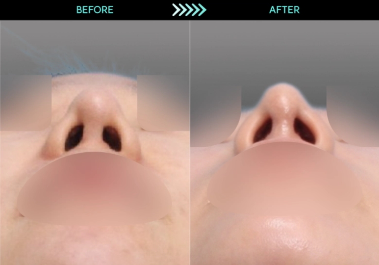 [Revision Rhinoplasty] 2 Months After Bulbous Nose Correction: The Standard Approach to Bulbous Nose and Short Nose Correction image 6