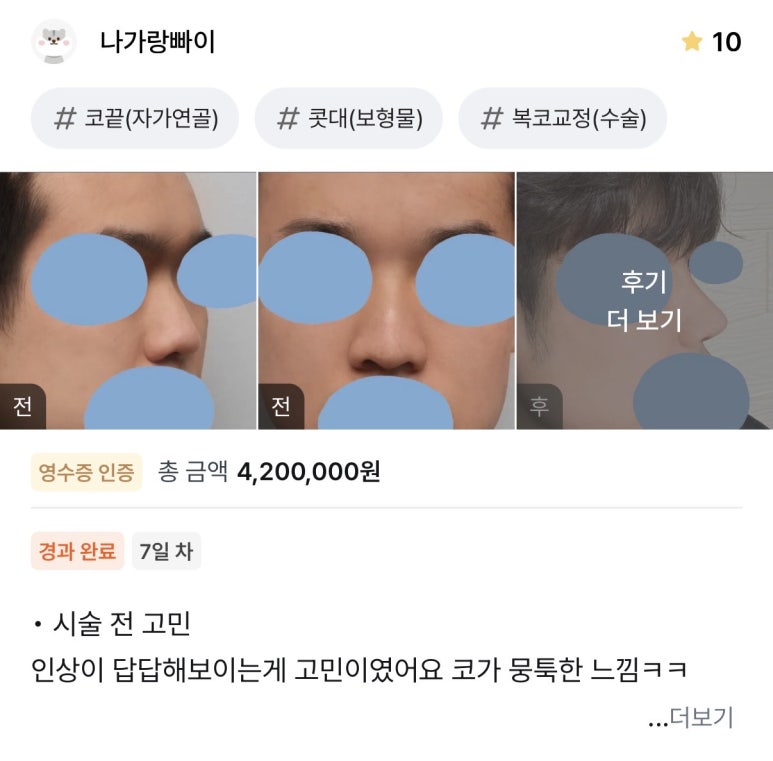 [Gangnam Plastic Surgery Male Nose Surgery Review] After tidying up the hump and bulbous nose that made me look stuffy, my T-zone and facial features looked completely alive! image 1