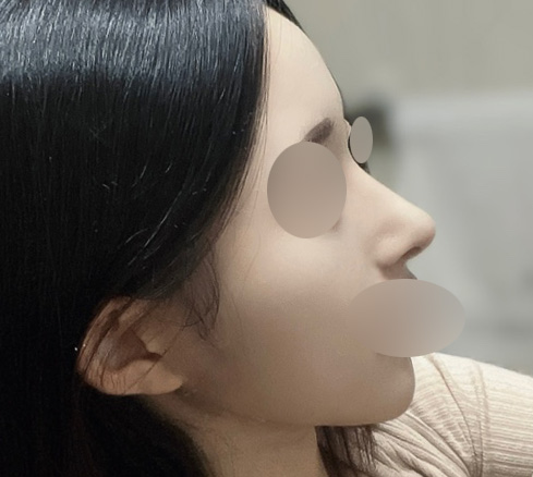 Hump Nose Surgery Is Not Simply a Procedure to Shave It Down. image 7