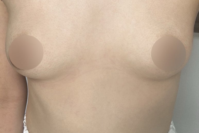 Where Should You Go for a Famous Breast Surgery Clinic Near Sinnonhyeon Station? image 3