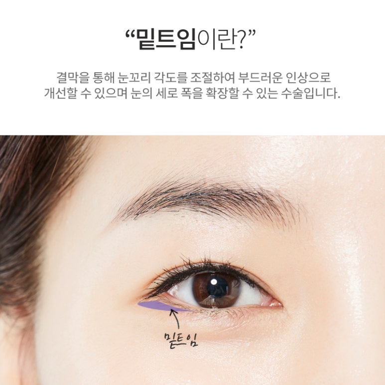 눈밑트임후기 부드러운 인상으로 변화 관련 이미지 5