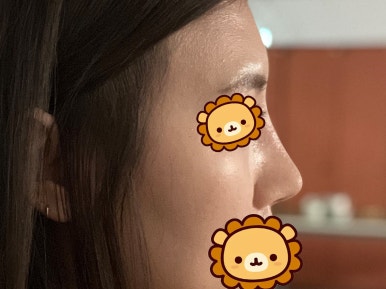 [강남성형외과 복코성형 후기] 각도 안 나오던 펑퍼짐한 코 모양.. 김준형 원장님 만나 정착했어요! 관련 이미지 9