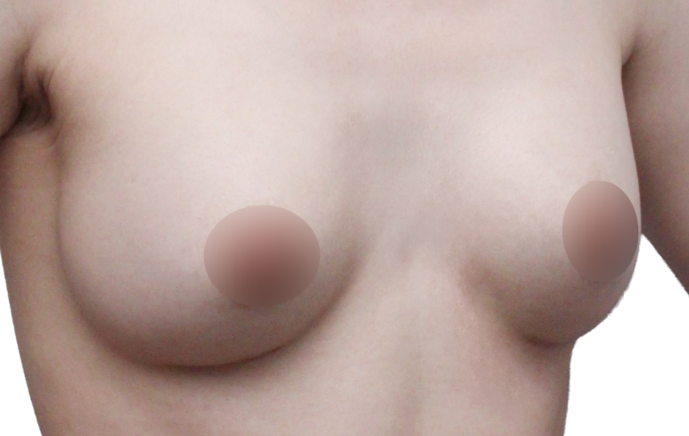 가슴재수술, 실패를 줄이기 위한 기준은? 관련 이미지 3