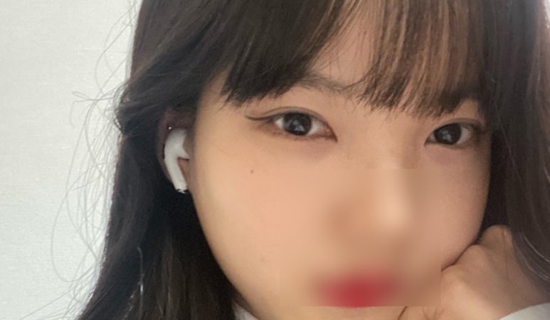 눈밑트임후기 부드러운 인상으로 변화 관련 이미지 3