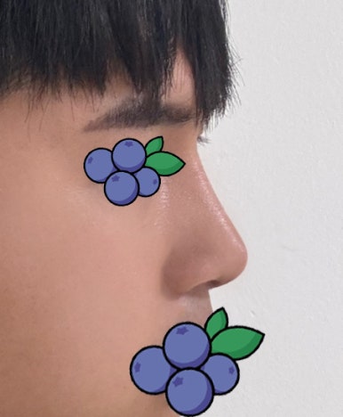 [강남성형외과 매부리코수술 후기] 울퉁불퉁한 옆 라인 고민.. 자가늑 덕분에 또렷한 콧대로 변신했어요! 관련 이미지 6
