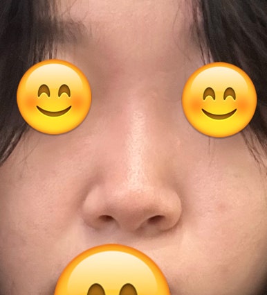 [강남역성형외과 복코성형 후기] 지인들도 부러워하는 매끄러운 코라인, 원장님 덕에 거울 볼 때마다 뿌듯해요 관련 이미지 4