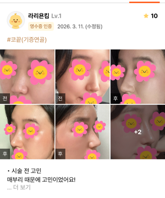 [Marble Plastic Surgery Nose Surgery Review] I Kept Worrying About My Hump Nose... I Should Have Had Surgery Sooner image 1