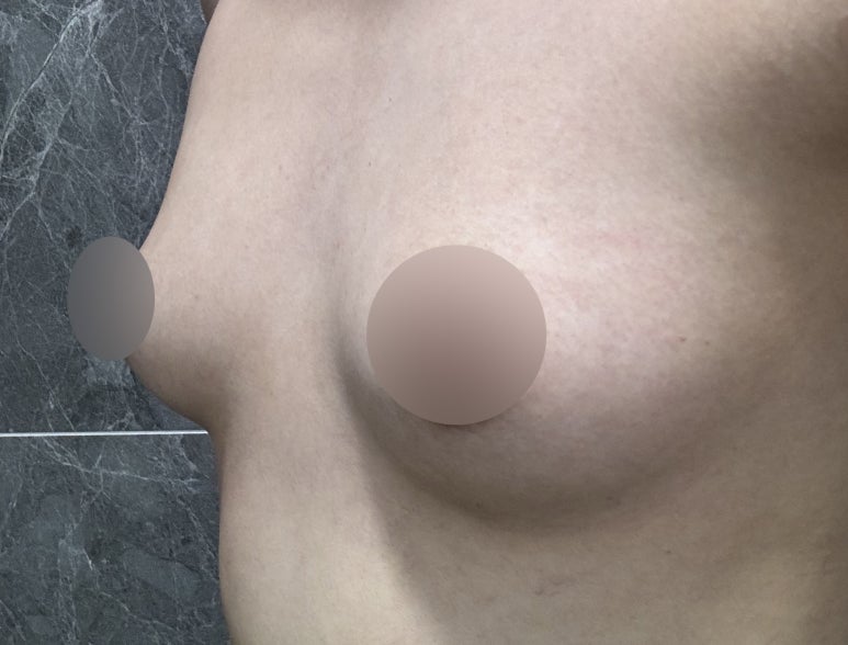 Where Should You Go for a Famous Breast Surgery Clinic Near Sinnonhyeon Station? image 2