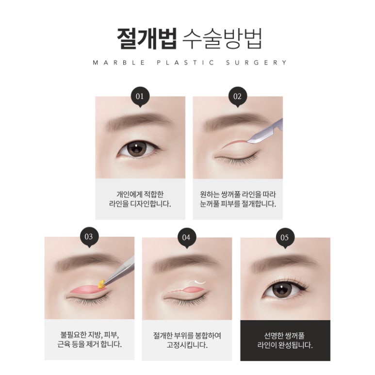 쌍커풀잘하는곳 찐으로 알아보세요 관련 이미지 7