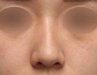 매부리코교정방법, 조화로운 코 라인의 핵심 관련 이미지 1
