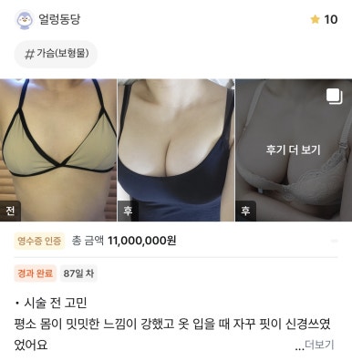 [강남성형외과 가슴확대수술 후기] 옷 태 안 살던 밋밋한 실루엣.. 서일범원장님 만나 워너비 라인됐어요! 관련 이미지 1