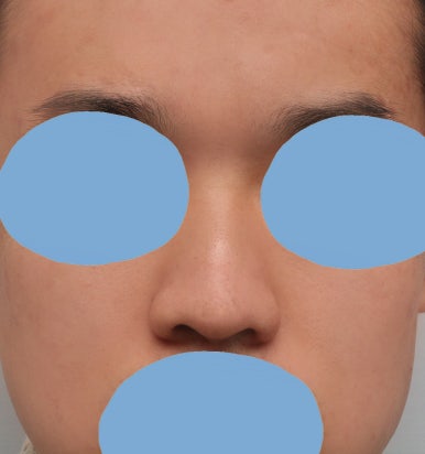 [Gangnam Plastic Surgery Male Nose Surgery Review] After tidying up the hump and bulbous nose that made me look stuffy, my T-zone and facial features looked completely alive! image 4