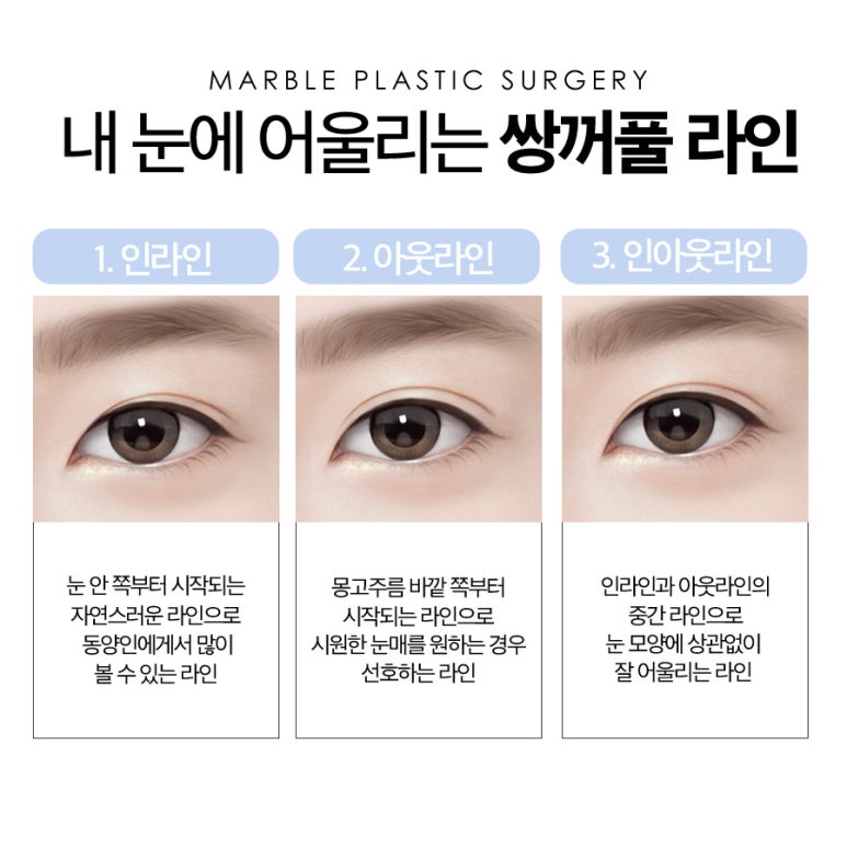 강남눈성형 자연스럽고 예쁜 라인 관련 이미지 4