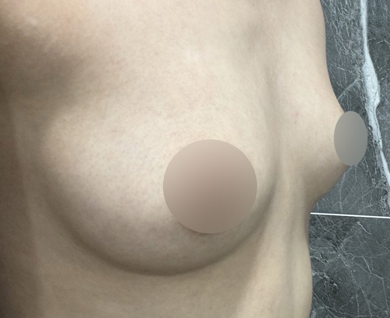 Where Should You Go for a Famous Breast Surgery Clinic Near Sinnonhyeon Station? image 4