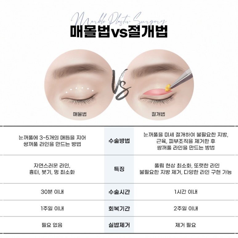 눈성형잘하는병원, 쌍꺼풀수술, 트임수술 관하여 관련 이미지 2