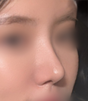 [마블성형외과 코성형 후기] 코수술 한 티도 안 나던 뭉툭한 복코... 재수술로 드디어 정착했어요ㅠㅠ 관련 이미지 5