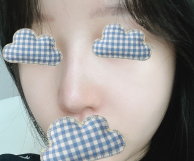 [강남역 성형외과 코재수술 후기] 얇은 코 고민 탈출! 원장님 디테일 덕분에 자려한 코 완성했어요ㅎㅎ 관련 이미지 4