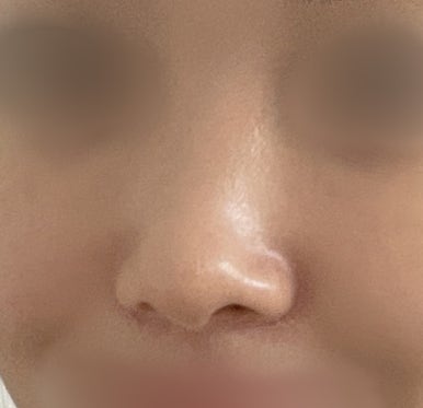 [Gangnam Plastic Surgery Clinic Rhinoplasty Revision Review] No matter how many surgeries I had, my nose still looked flat and wide... Now it has finally settled into a beautiful shape haha image 4