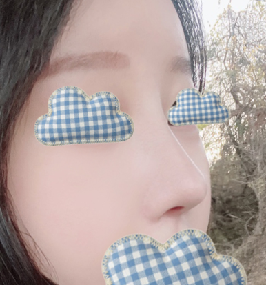[강남역 성형외과 코재수술 후기] 얇은 코 고민 탈출! 원장님 디테일 덕분에 자려한 코 완성했어요ㅎㅎ 관련 이미지 7