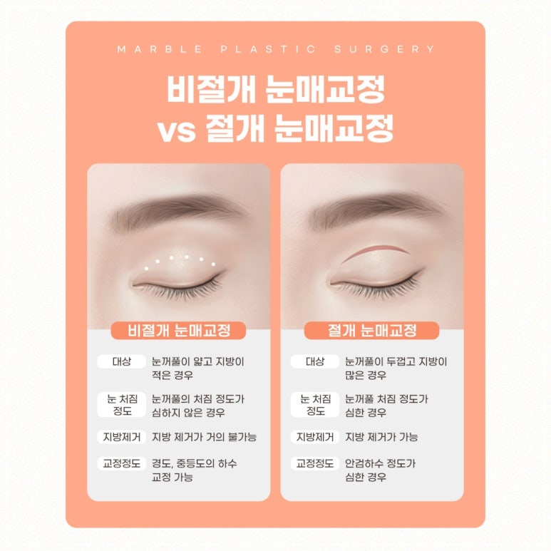 강남역 고등학생눈매교정잘하는곳, 시술방법, 장점, 필요성 관련 이미지 8