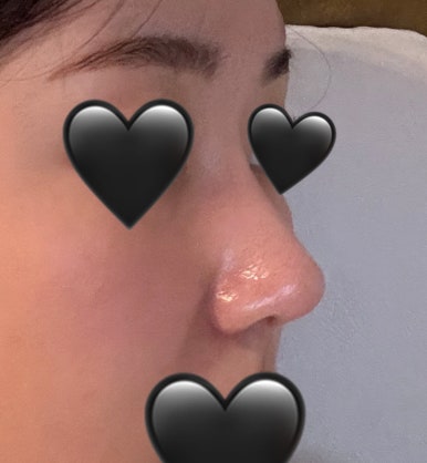 [Gangnam Plastic Surgery Rhinoplasty Review] I Was Worried About My Bulbous Nose.. It Turned Out Beautiful While Healing Well Without Inflammation or Side Effects hehe image 8
