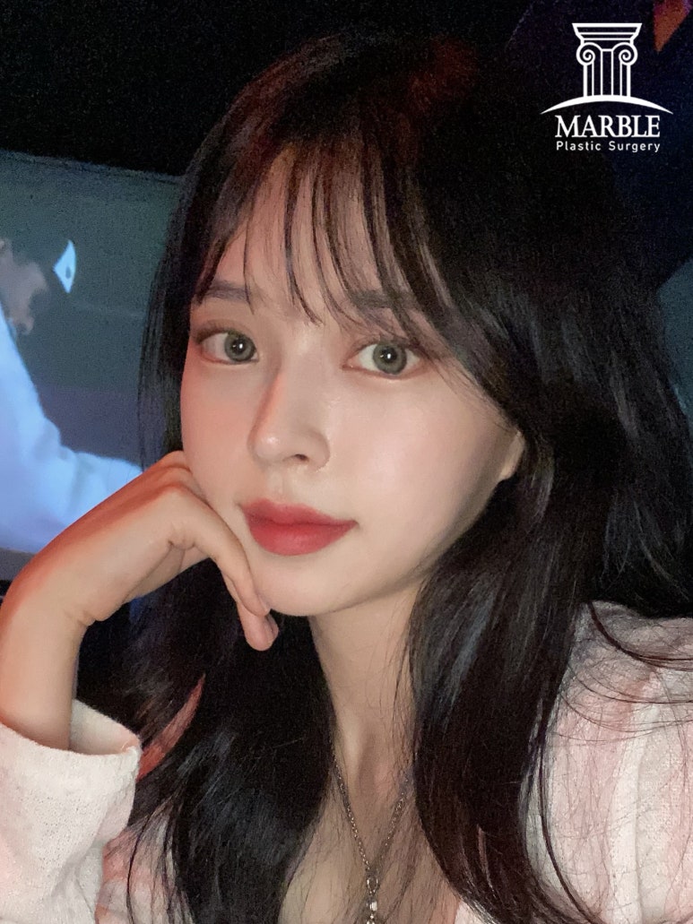 더 이상 쌍꺼풀재수술은 그만, 내 눈은 왜 잘 풀릴까? 관련 이미지 6