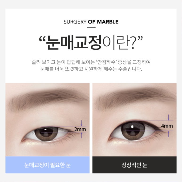 눈매교정 부작용 무엇이 있을까? 관련 이미지 2