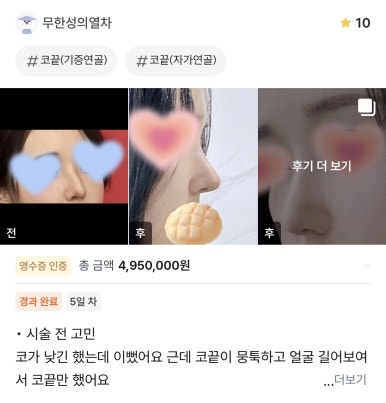[강남역 성형외과 코수술 후기] 김준형 원장님 덕분에무보형물로 코끝교정 성공! 예쁜 직반 라인 얻었어요ㅎㅎ 관련 이미지 1