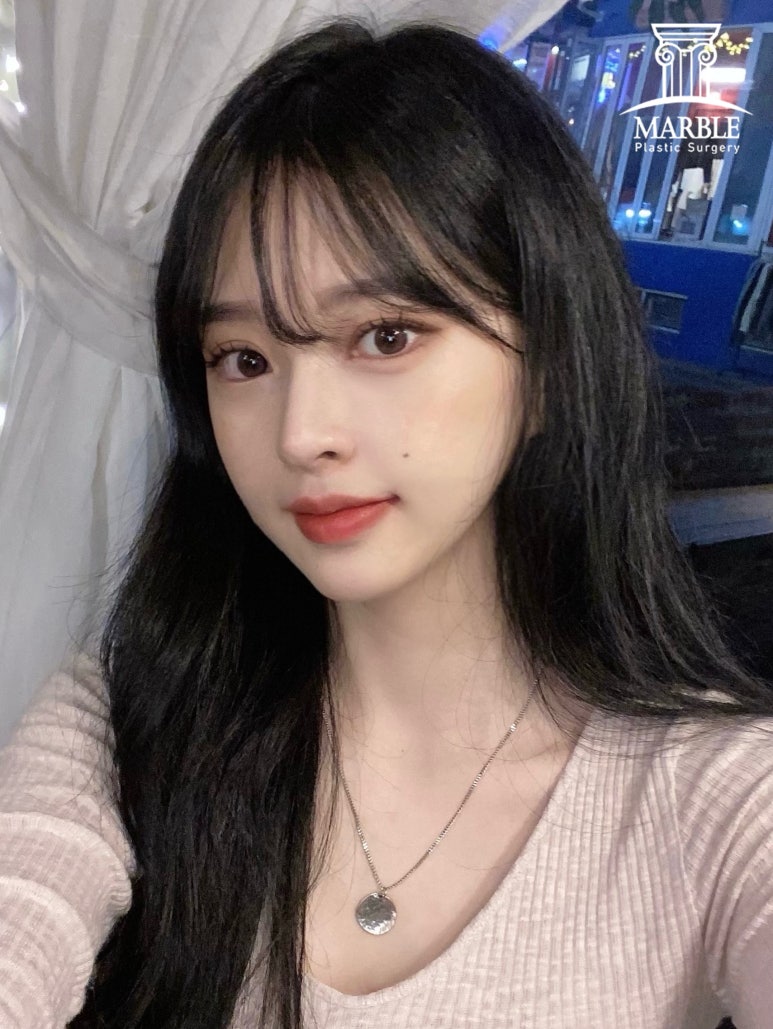 더 이상 쌍꺼풀재수술은 그만, 내 눈은 왜 잘 풀릴까? 관련 이미지 3