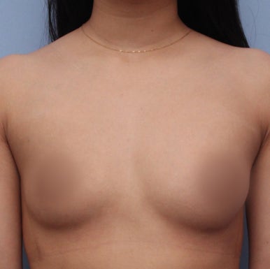 [Gangnam Plastic Surgery Breast Augmentation Review] I Used to Feel Self-Conscious About My Slim Figure Without Any Volume… Now I Have Beautiful Volume That Suits Me Perfectly! image 4