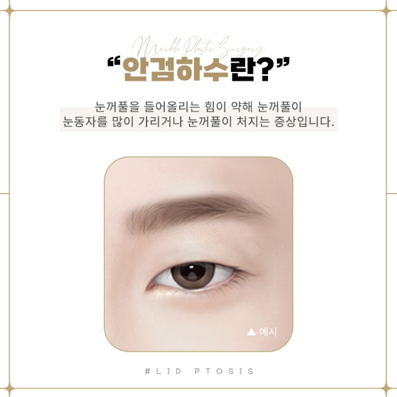 눈매교정부작용 벗어날 방법 알아보기 관련 이미지 5