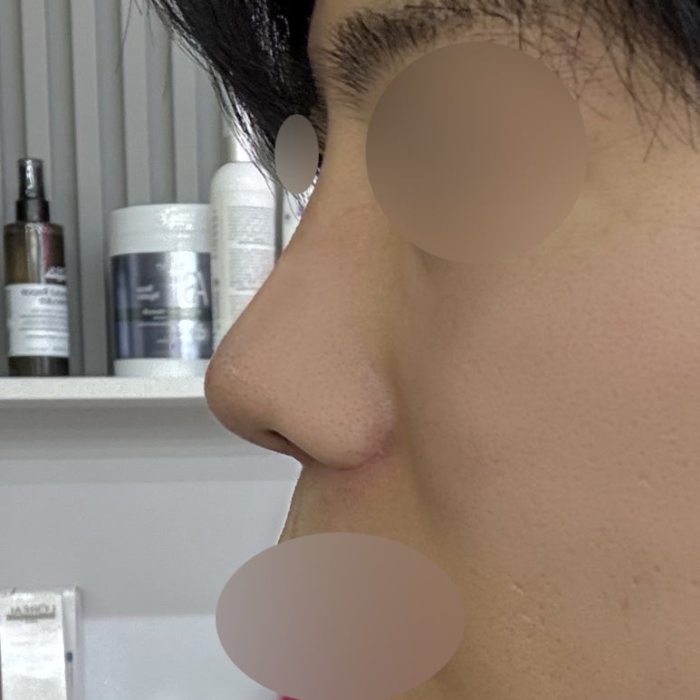 Improving Your Impression Before and After Male Rhinoplasty image 6