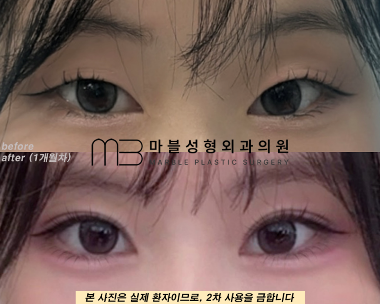 자연유착쌍꺼풀후기 눈매를 더욱 또렷하게 관련 이미지 12