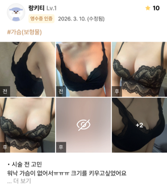 [마블성형외과 가슴성형 후기] 가슴이 워낙 없어서 고민이었는데... 이제는 사이즈, 모양, 촉감 다 대만족ㅠㅠ 관련 이미지 1