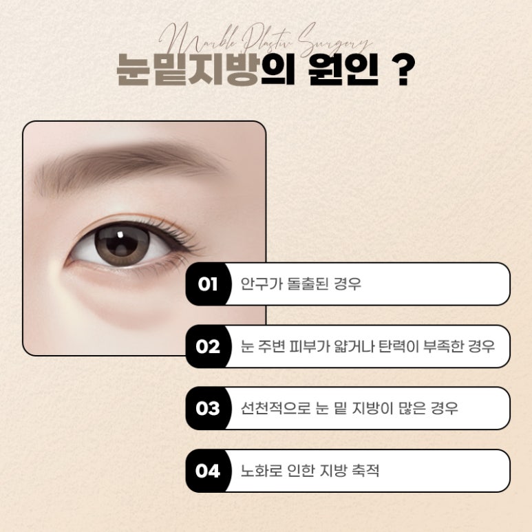눈밑지방재배치 다크서클에 도움될 수 있을까 관련 이미지 2