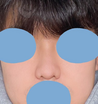 [Gangnam Plastic Surgery Male Nose Surgery Review] After tidying up the hump and bulbous nose that made me look stuffy, my T-zone and facial features looked completely alive! image 8