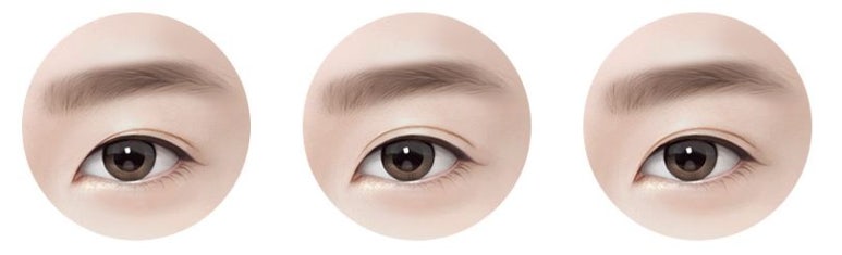 쌍수라인 실밥제거후 두갈래로 잡힌 경우 마블성형외과의원 관련 이미지 5