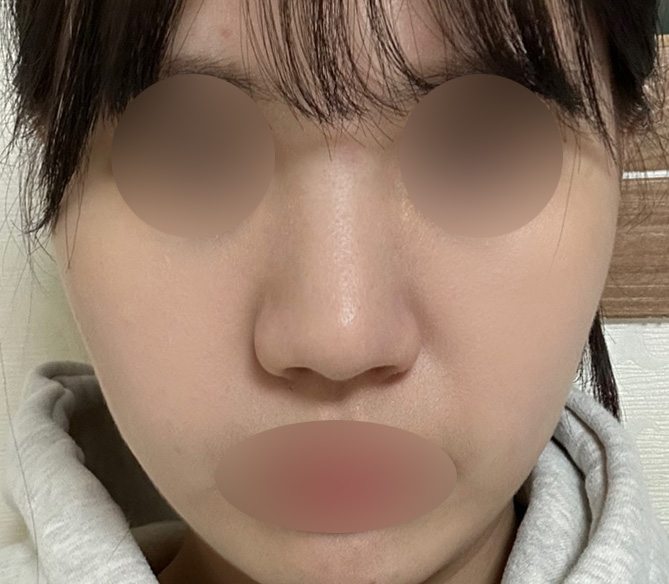 복코수술비용, 정확하게 찾아봐야 하는 이유 관련 이미지 2