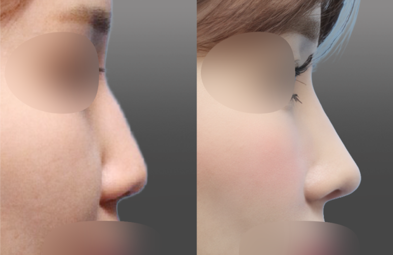 [First Rhinoplasty] Month 2 of Hump Nose Correction: The Standard for Implant-Free Hump Nose Correction image 5